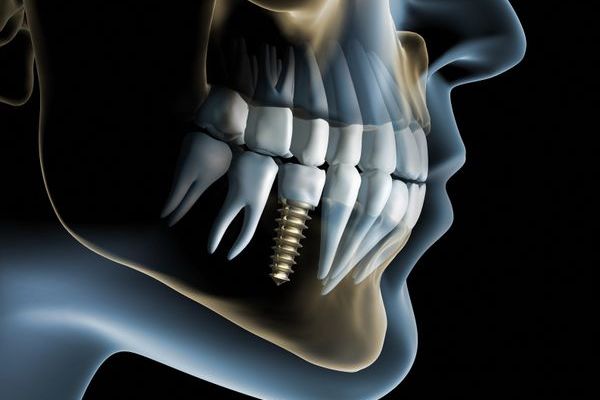 Riabilitazione Implantare e Protesica